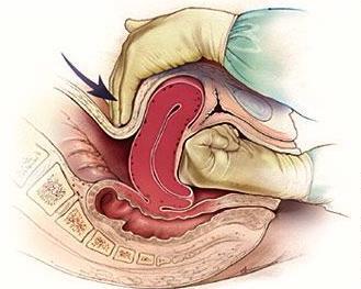 Bimanuel uterin kompresyon Uterus ön ve arka yüzüne her iki elle