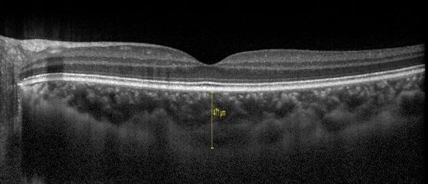 kalınlığı subfoveal bölgeden hiperreflektif retina pigment epitelinin arka kenarı ile koroid/sklera bileģim yeri arası mesafe olacak Ģekilde cihazın kullanılıp manuel olarak ölçüldü (ġekil3.1).