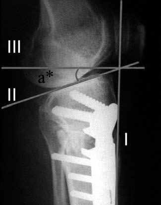 Özkaya ve ark. Açık kama yüksek tibia osteotomisi sonrasında patella yüksekliği ve tibial eğim açısındaki değişiklikler 267 Şekil 1.