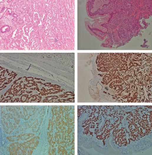 Gastrik karsinoid Toplam 3 vaka (12, 13 ve 15 yıl) Jianu CS, et al.