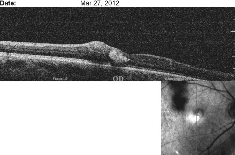 Endoskopik Sinüs Cerrahisi Sonrası Beklenmeyen Retina İçi Kanama: Olgu Sunumu ait retinal ödem saptandı (Resim 2). Fundus floresein anjiografisinde retina içi kanama doğrulandı (Resim 34).