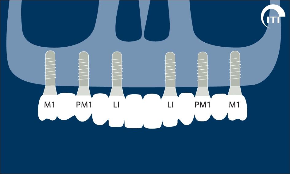 yüklemeyle klasik yüklemenin farkı bulunmamıştır ve tüm implantlar başarılı olmuştur (15).