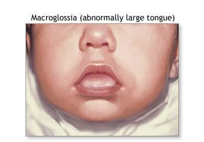4. Macroglossia Dil hacminin normalden büyük olmasının prenatal gelişimle ilgili olduğu düşünülmektedir.