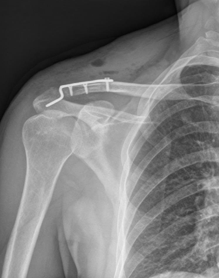 Șekil 2. Ameliyat sonrası direkt grafi. Șekil 3. Ameliyat sonrası geç dönemde plakta kırılma. Ameliyat sonrası 4 6 hafta süre ile omuz kol askısı kullanıldı.