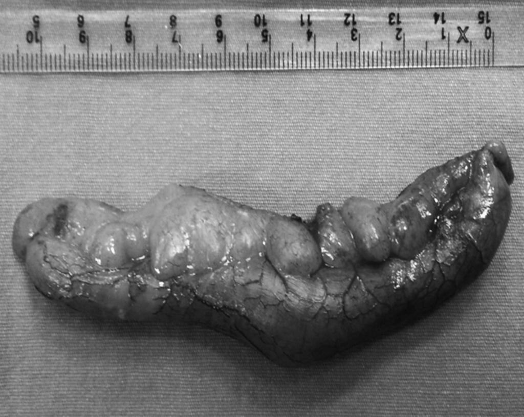 Abdominal exploration revealed an edematous and inflamed appendix with 200 300 ml of serous fluid around it. The remaining intra abdominal structures were normal in appearance and color.