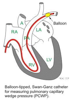 Pulmoner Arter Basıncı Sol kalp fonksiyonu hakkında bilgi verir. Pulmoner arter kateterine, Swan Ganz kateteri de denir. Ölçüm sağ ventrikülden yapılır.