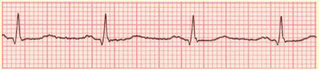 Tipik İşaretlere Örnekler Elektrokardiyografi (EKG) işareti kalbin