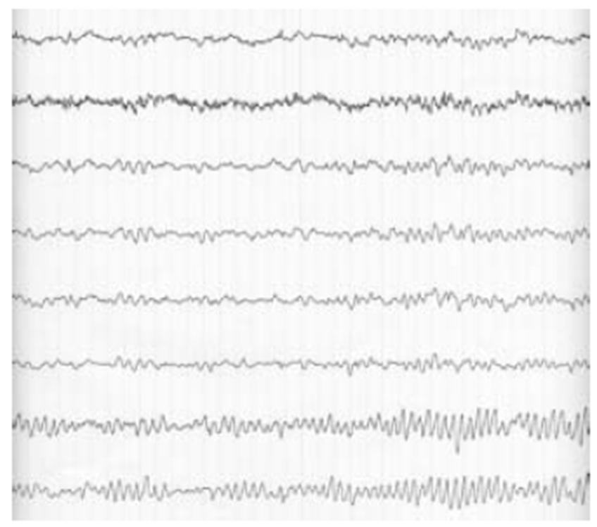 Tipik İşaretlere Örnekler Elektroenselefogram (EEG) işaretleri beyindeki