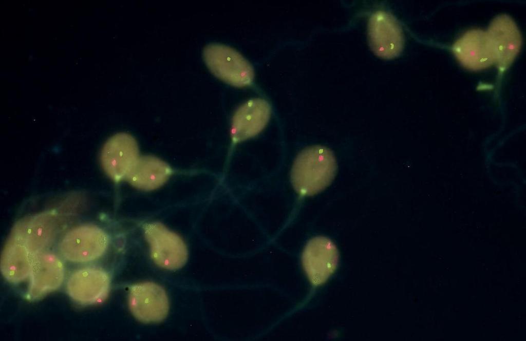 Şekil 10. Sperm çekirdeğine 13-21 lokus spesifik prob ile yapılan floresan in situ hibridizasyonda (FISH) dizomi 13 gözükmektedir. Kromozom 13 yeşil renk ve kromozom 21 kırmızı renk ile işaretlidir.