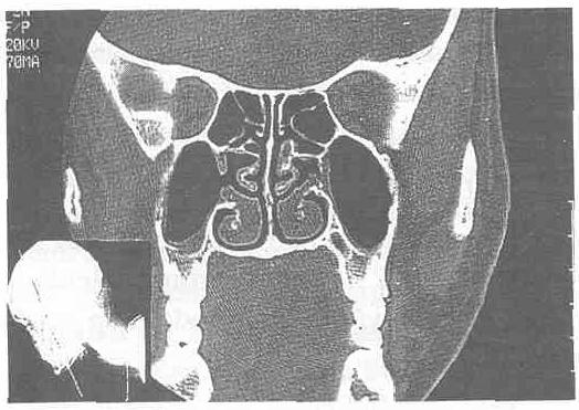 Şekil-5 : SK 25 yaşında erkek hasta (Preoperatif CT) Bilateral paradoks orta konka Şekil-6 : SÇ 22 yaşında bayan hasta (Preoperatif CT) Bilateral sağda