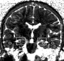 Hastalar n tamam klinik ve EEG ile temporal lob epilepsi tan s alm ş hastalard. Olgular n birine tan sonras anterior temporal lobektomi uyguland.