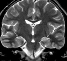 A B Resim 4. Bilateral MTS bulgular. A. T2 FSE sekansta her iki hipokampüs içinde intensite art fl izleniyor (ok). B. T1 IR sekansta her iki hipokampüs içinde atrofi, intensite kayb ve homojenitede azalma izleniyor (ok).