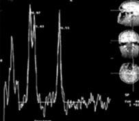 162 Haziran 2003 Çal şmam zda, MR volümetri ile sağ-sol hacim fark na göre %88 oran nda hipokampal atrofi saptand.