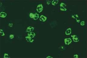 10.4. canca formalin dirençli (PR3 ANCA) Mikroskobik görünüm İlgili antijenler İlişkili olduğu hastalıklar Sonuç Çalışma yöntemi Çalışılan hücre/doku Referans değer Açıklama/öneri Resim 10.4.1. Etanolle fikse granülositler (x40) RAPOR ÖRNEĞİ Etanolle fikse granülositler: Sitoplazmada dağınık granüller ve santral intralobüler kuvvetlenme şeklinde floresan boyanma görülür.