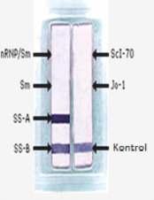 ELISA testinde kullanılan antijenler tek zincirli DNA (ssdna) ile kontamine olabilmekte, bu nedenle tanı ve izlemde değeri olmayan ssdna antikorları yalancı pozitif sonuçların oluşmasına neden