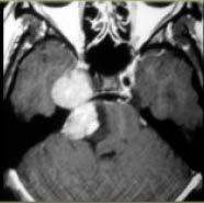 tümörler Gangliyogliyoma, pilositik astrositoma