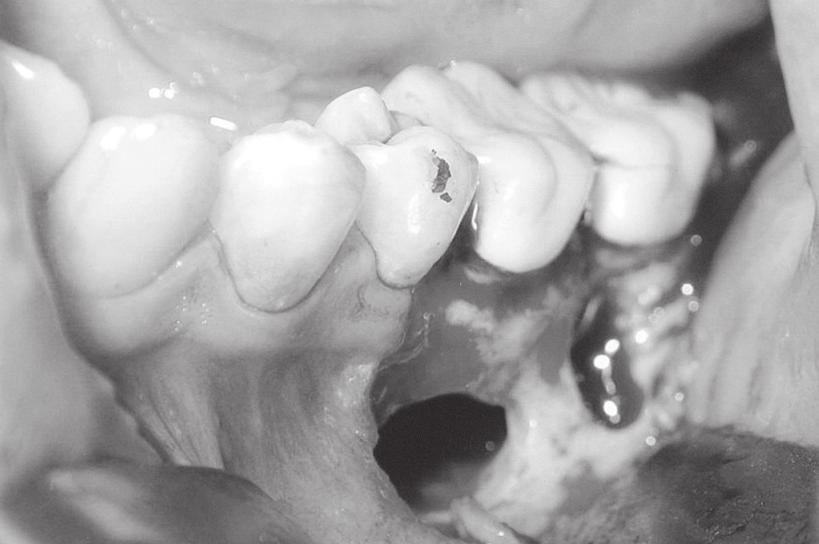 GİRİŞ Pulpal ve periodontal dokuları aynı anda içeren lezyonların kaynağı incelendiğinde bu lezyonların; primer endodontik, primer periodontal ve gerçek kombine lezyonlar olarak 3 gruba ayrılabildiği
