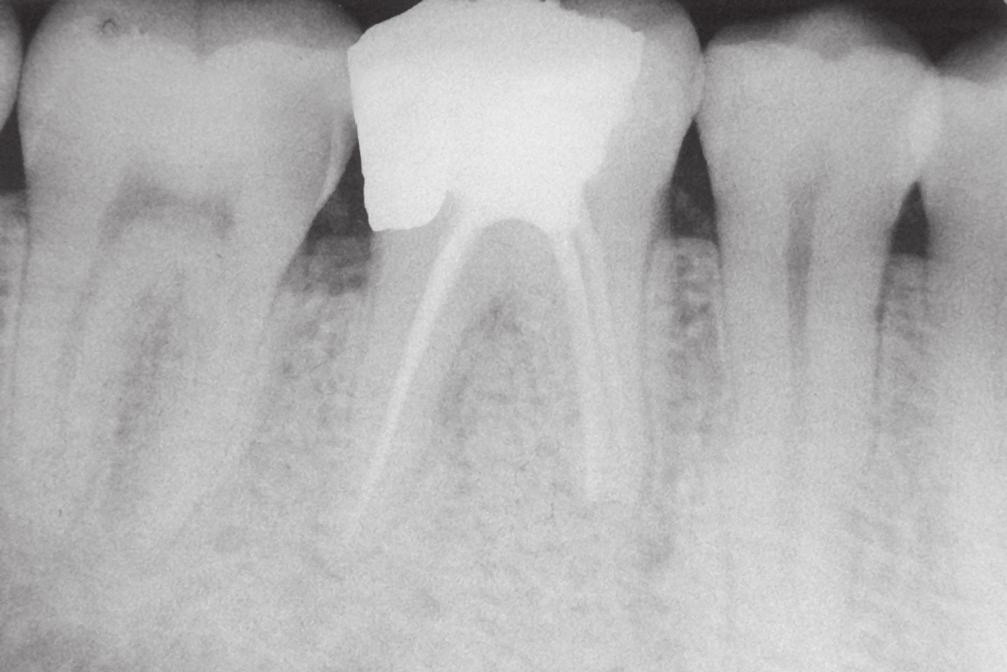 Cep derinliği ölçümleri, periodontal sond yardımıyla her diş için 6 noktada ölçüldü ve lezyon komşuluğundaki en derin ölçüm değeri kaydedildi. Dişlerin periapikal radyogramı alındı.