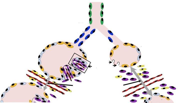 ETYOPATOGENEZ patofizyoloji Hava yolu hasarı Alveollerin azalması Alveolar duvarlarda kalınlaşma Alveolar hava boşluğu ve gaz değişim alanında azalma Vasküler hasar Damar sayısında azalma Adventisyal