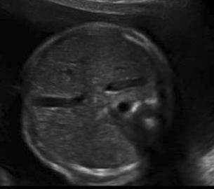 TANI -ultrason Rutin antenatal ultrason Abdomende