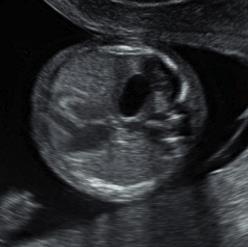 TANI -ultrason Rutin antenatal ultrason Abdomende midenin izlenememesi Kardiak kesitte ilave hipoekoik kitle