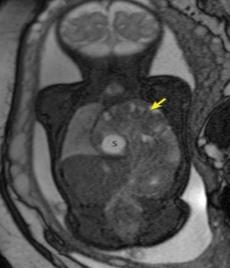TANI MRI MRI İçerik tanımlamak için mükemmel Karaciğer varlığını kesin teşhis eder Yüksek sinyal T1WI, düşük sinyal