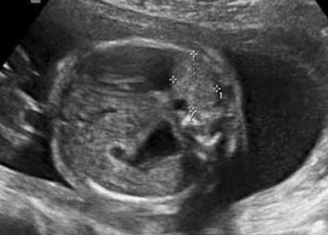 htm Deprest J, Prenatal management of the fetus with isolated congenital diaphragmatic hernia in the era of the TOTAL trial.