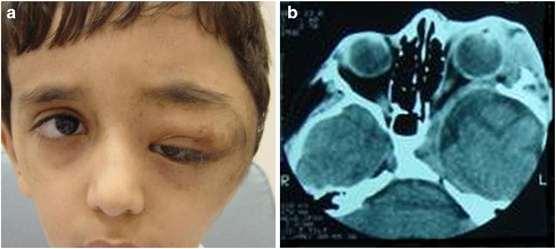 5) Optik glioma 6) Sfenoid kemik