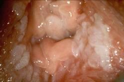 Vulvar Intraepithelial Neoplasia (VIN) ABD de ve tüm dünyada VIN insidansı