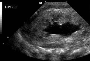 Prenatal Hidronefrozlu