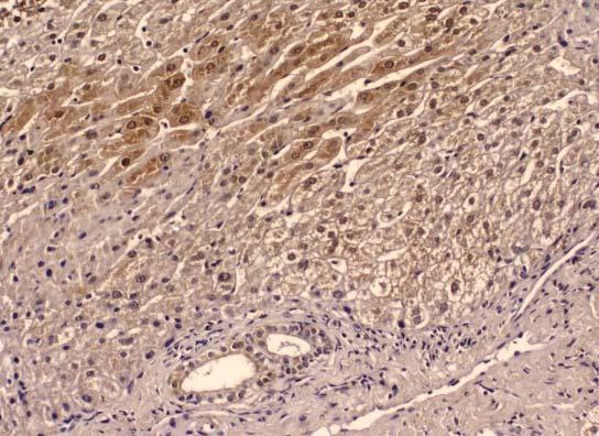 Resim 4: Kronik viral C hepatitte hepatositlerde ve safra duktus epitel hücrelerinde ortakuvvetli boyanma, yaygınlık u: 2 (immünperoksidaz X200).