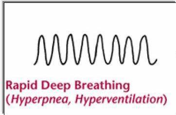 Solunum şekli Santral nörojenik hiperventilasyon: Devamlı, düzenli ve hızlı