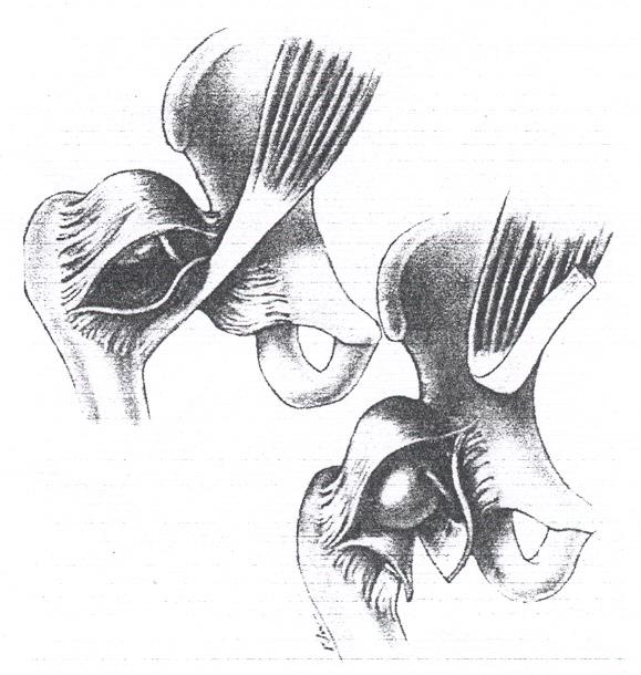 Şekil 1: İliopsuas tendonu ve kum saati görünümü 2.9.2.2. Ligamentum Tereste Meydana Gelen Değişiklikler: Çıkık olan kalçada ligamentum teres genellikle uzar ve hipertrofiye uğrar.