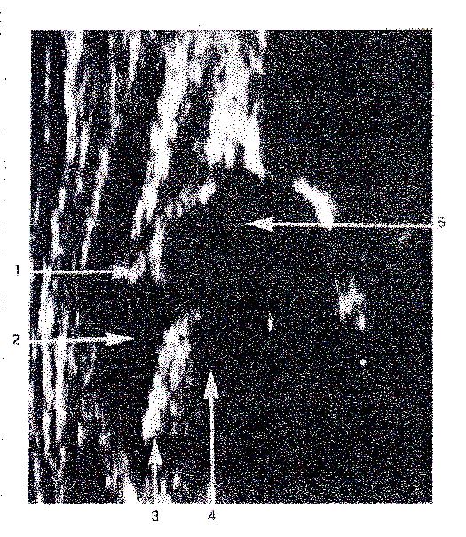 3.2.5.3 Ultrasonografide Kullanılan Önemli Terimler : Ultrasonografik değerlendirme sırasında 3 temel farkın bilinmesi gerekir.