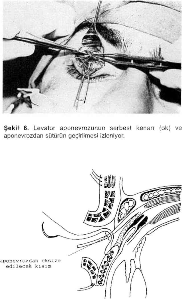 LEVATOR APONEVROZ CERRAHİSİ Mehmet ÜNAL Şekil 5.