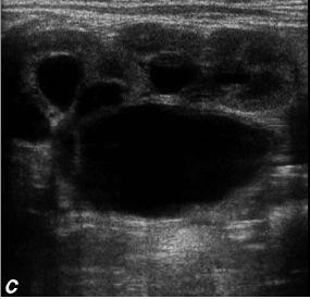 renal parankim, pelvis ve kalikslerin ultrasonografik görünümüne dayanan 0-IV arası sayısal derecelendirme sistemini tanımlamıştır (Şekil 2).