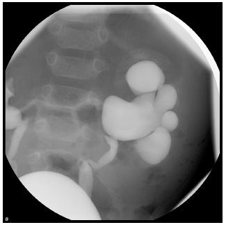 gibi hidronefrozun diğer nedenlerini dışlamak için işeme sistoüretrografi önerilir. [10] ÜPB darlığı olgularında düşük dereceli reflü sıktır.