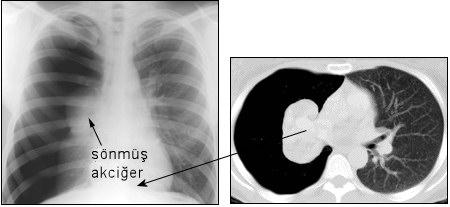 Elevated pressure in neck veins occurs in tension pneumothorax Chest film definitive. Inspiratory and expiratory films may enhance contrast between air and lung parenchyma.