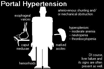 Portal Hipertansiyon Kc Hastalığı ve Laboratuvar özofagus varisleri caput medusa hemoroidler belirgin asit hipersplenizm: -orta düzeyde anemi -nötropeni -trombositopeni ± Karaciğer yetmezliğine ait