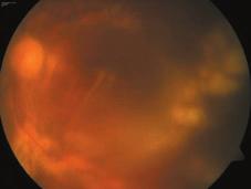 Olgu 2, sag göz fundus görünümü. Arka kutupta pigment epitel degiflimleri ve çevresinde beyaz-krem rengi lezyonlar kayetleri azalm flt r.