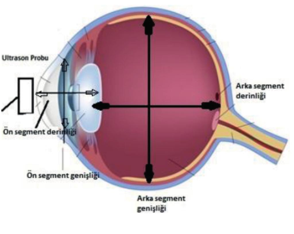 Gözün ultrasonografik muayenesi ve göz içi basıncın ölçülmesi Göz içi basıncı normal ve göz içi basıncı yüksek olan olgularda göz içi basınç ve ultrason parametreleri sonuçları independent t testi