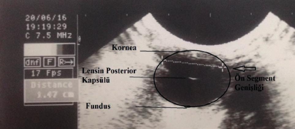 32 nolu köpek, Ön Segment Derinliği (0,92 cm) Resim 4. 7 nolu köpek, Ön Segment Genişliği (1.47 cm) Resim 5. 5 nolu köpek, Arka Segment Derinliği (0.77 cm) koik olarak belirlendi.