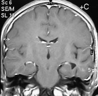 TARTIfiMA Merkezi sinir sisteminin nadir görülen tümörlerinden olan gangliogliomlar, tüm MSS tümörleri içinde yaklafl k %0,5 oran nda görülme s kl - na sahiptirler.
