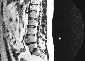 olan bir spinal epidural non-hodgkin lenfoma vakası bildiriyoruz.