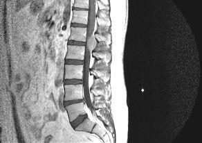 Özgeçmişinde ek bir hastalığı yoktu. Laboratuar bulguları normal sınırlar içerisindeydi. Hastanın intervetrebral disk hastalığı ön tanısı ile çekilen MRG bulguları değerlendirildi.