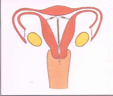 Enfeksiyon sadece steril olmayan uygulamalarda ilk 2-3 haftada görülür. Servikal ektopi, uterin kaviteyi distorsiyona uğratmayan myomlar engel değildir.