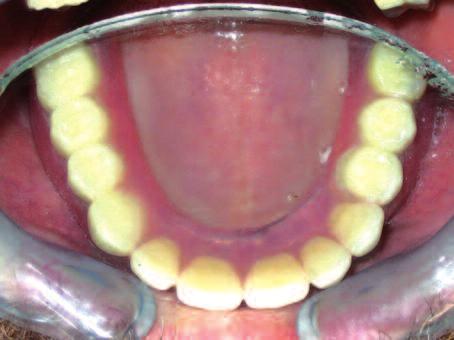 2 Belirtilen nedenlerden dolayı bu vakada implant destekli overdenture seçeneği hem estetik, hem de hijyen açısından avantaj olabilir.