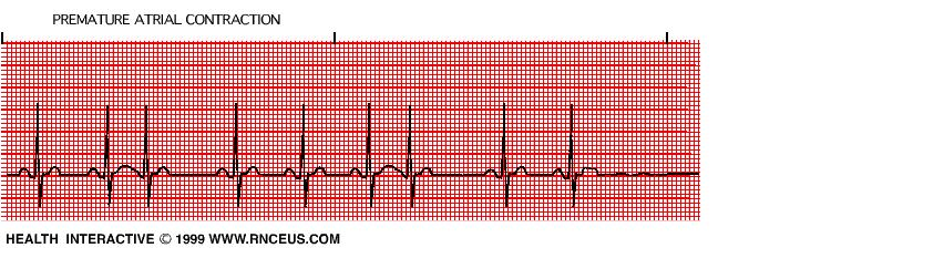 Prematür atrial