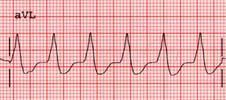 Eğer vuru ventriküler orjinli ise QRS geniş ve acayip-tuhaftır,