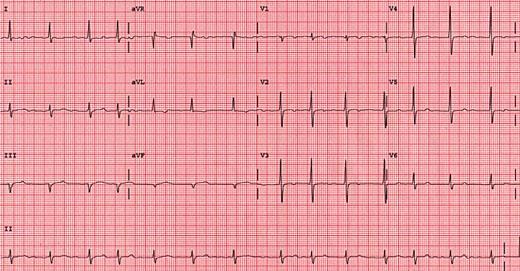 C) Atrial fibrillation. Bu aritmiyi çok sık göreceksiniz.